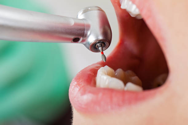 Best Emergency Wisdom Teeth Removal in Cheyenne, WY